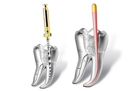 Endodonti (Kanal) Tedavisi