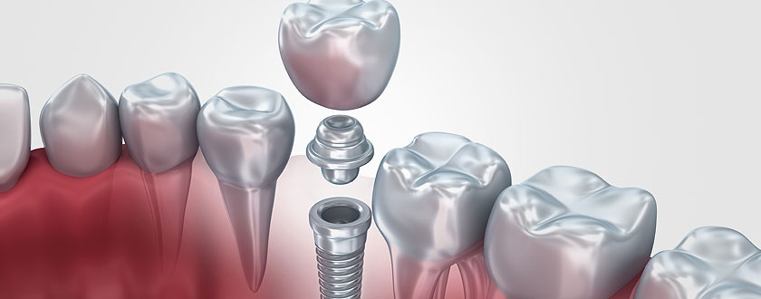 İmplant Diş Tedavisi